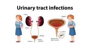 Read more about the article Urinary Tract Infections का परिचय, लक्षण व रोकथाम कैसे करें