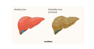 Read more about the article Liver Disease की परिभाषा, कारण, लक्षण व रोकथाम के उपाय