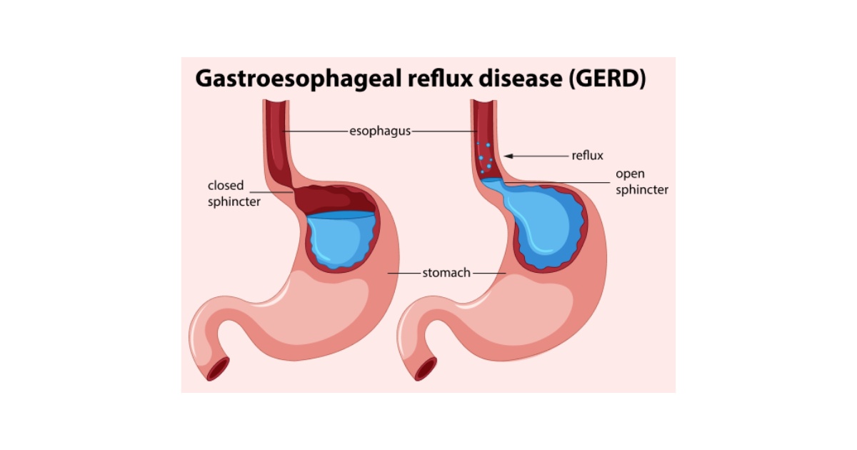 Gastroesophageal Reflux Disease