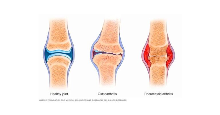 Arthritis Disease