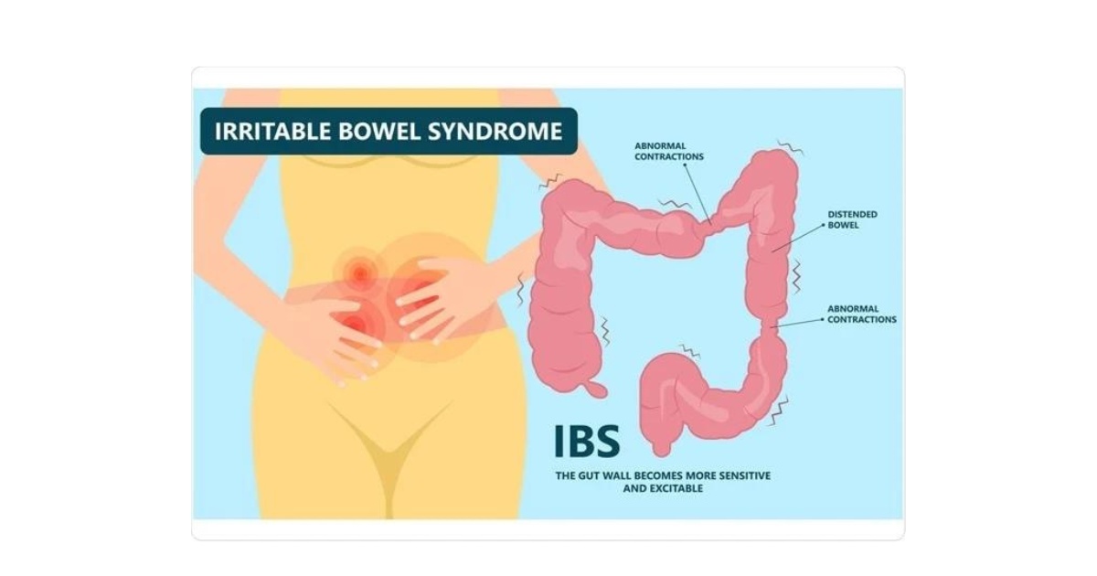 Irritable Bowel Syndrome Disease