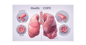 Read more about the article COPD Disease की परिभाषा, लक्षण व कारण