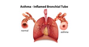 Read more about the article Asthma Disease की परिभाषा, लक्षण व कारण