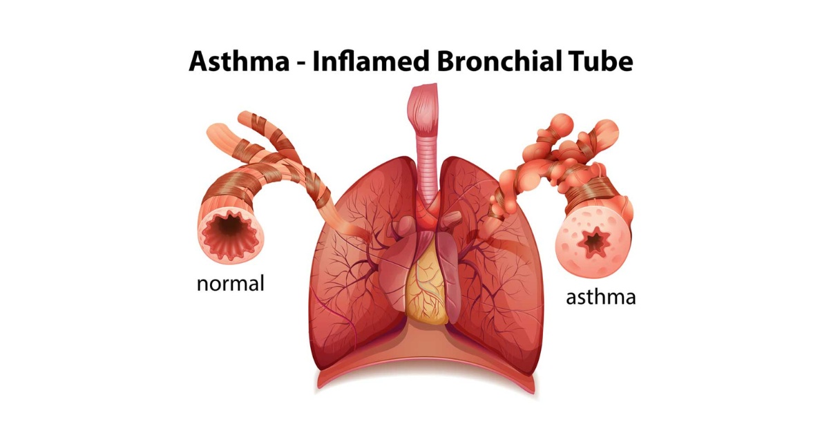 Asthma Disease