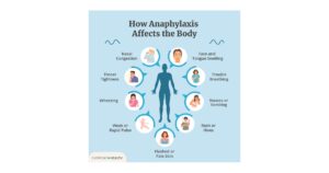 Read more about the article Anaphylaxis Disease की परिभाषा, कारण, लक्षण व रोकथाम के उपाय