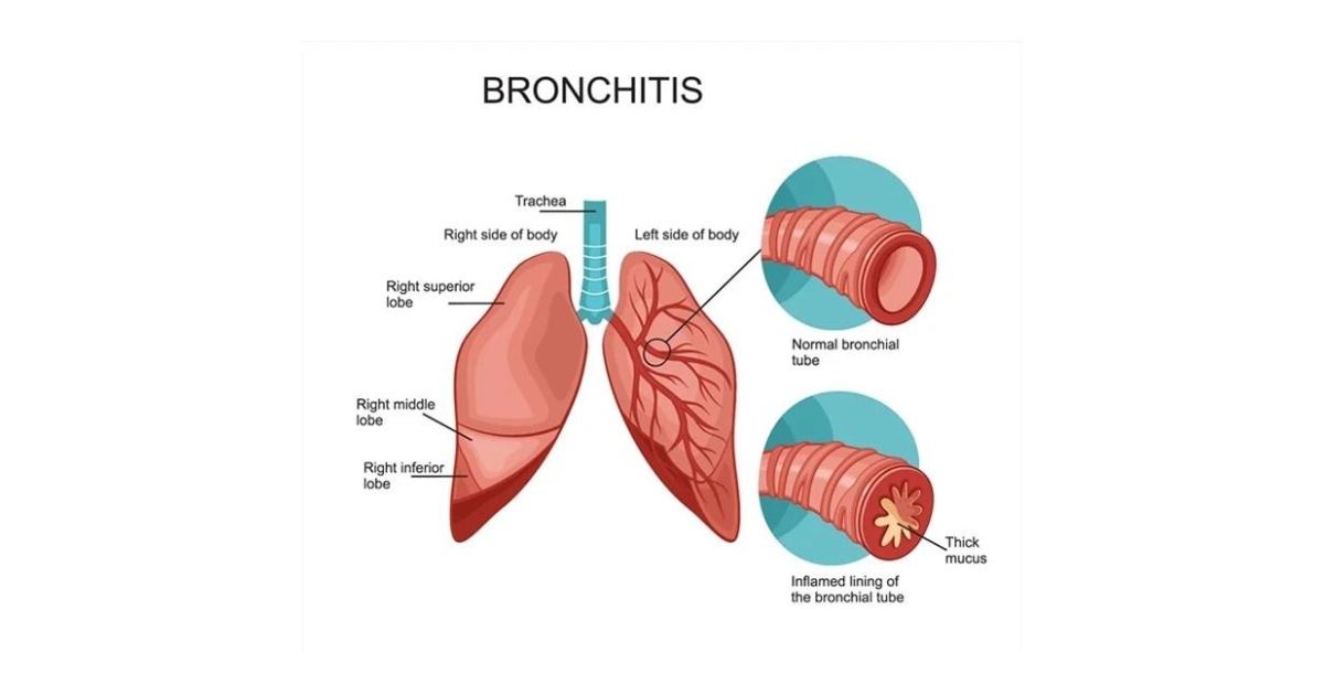 Bronchitis