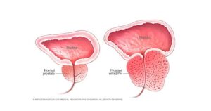 Read more about the article Benign Prostatic Hyperplasia की परिभाषा, कारण व रोकथाम के उपाय